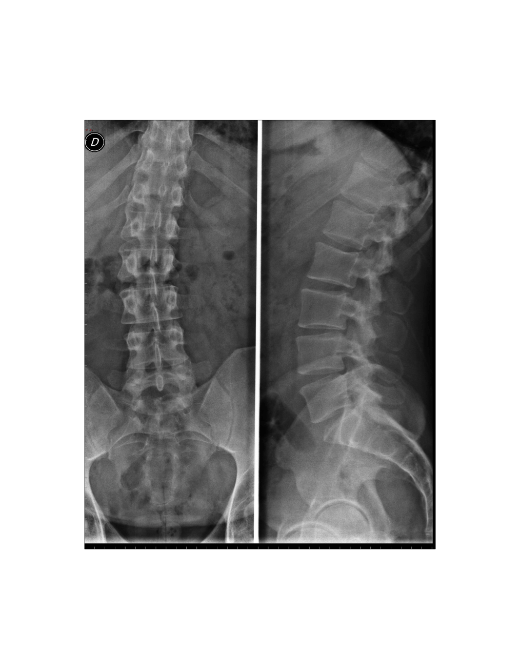 Lumbar spine — AP & lateral